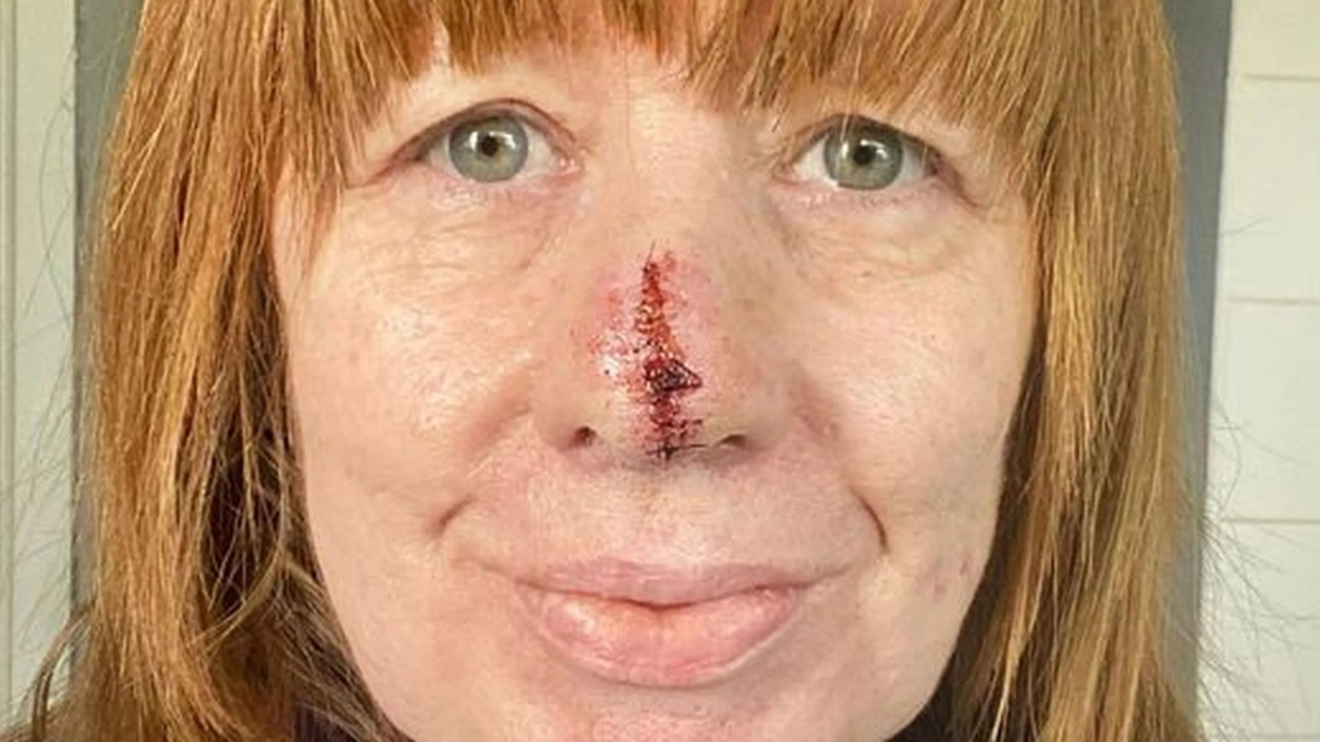 Mamá pierde la punta de la nariz después de que los médicos descartaran un ‘punto infectado’ solo para que su DENTISTA descubriera cáncer