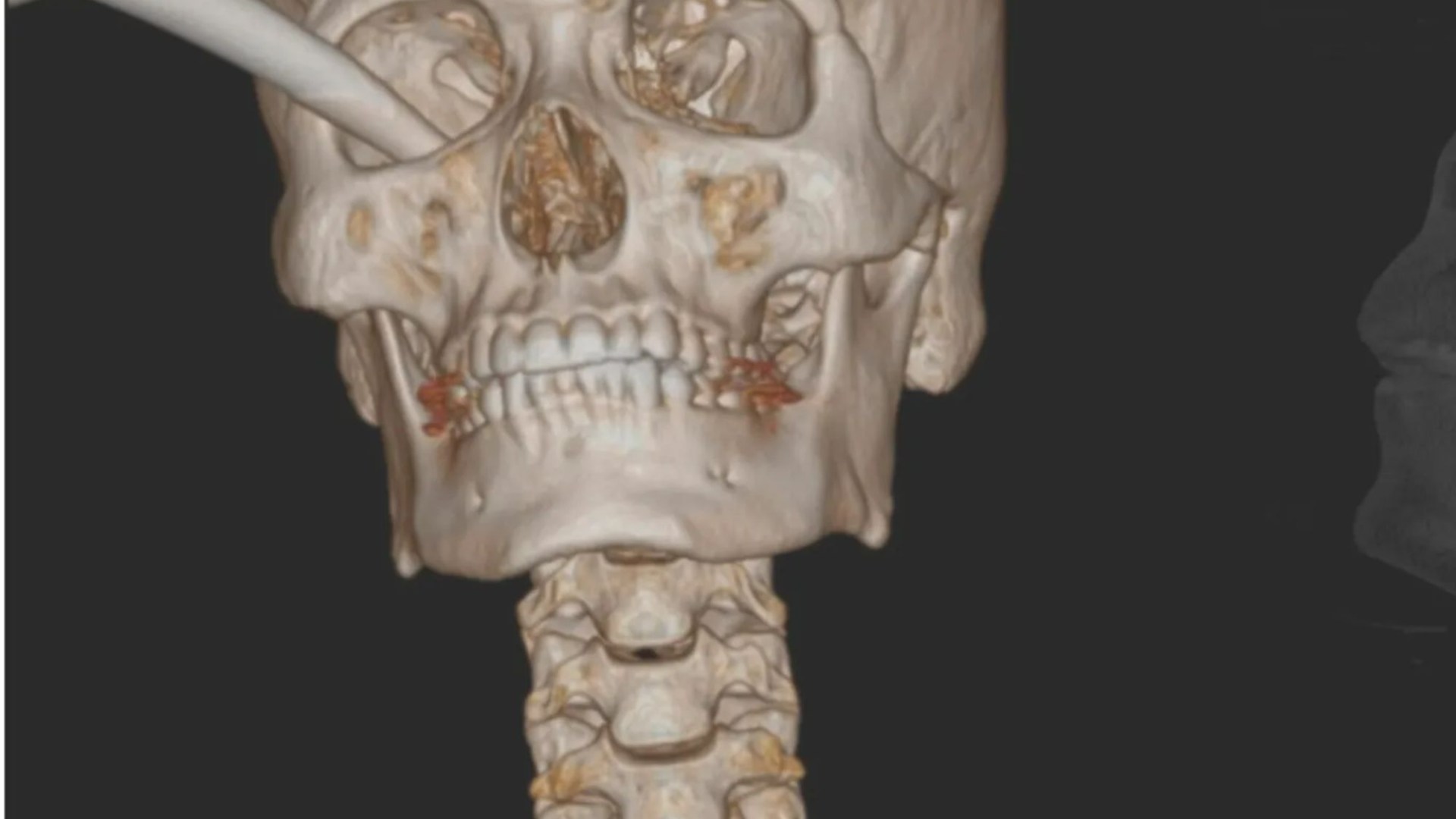 Escaneos impactantes muestran una palanca de freno alojada en la cuenca del ojo de un adolescente después de un awful accidente